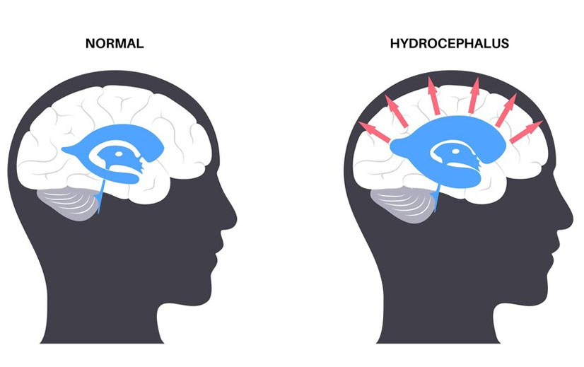 Hydrocephalus Surgery